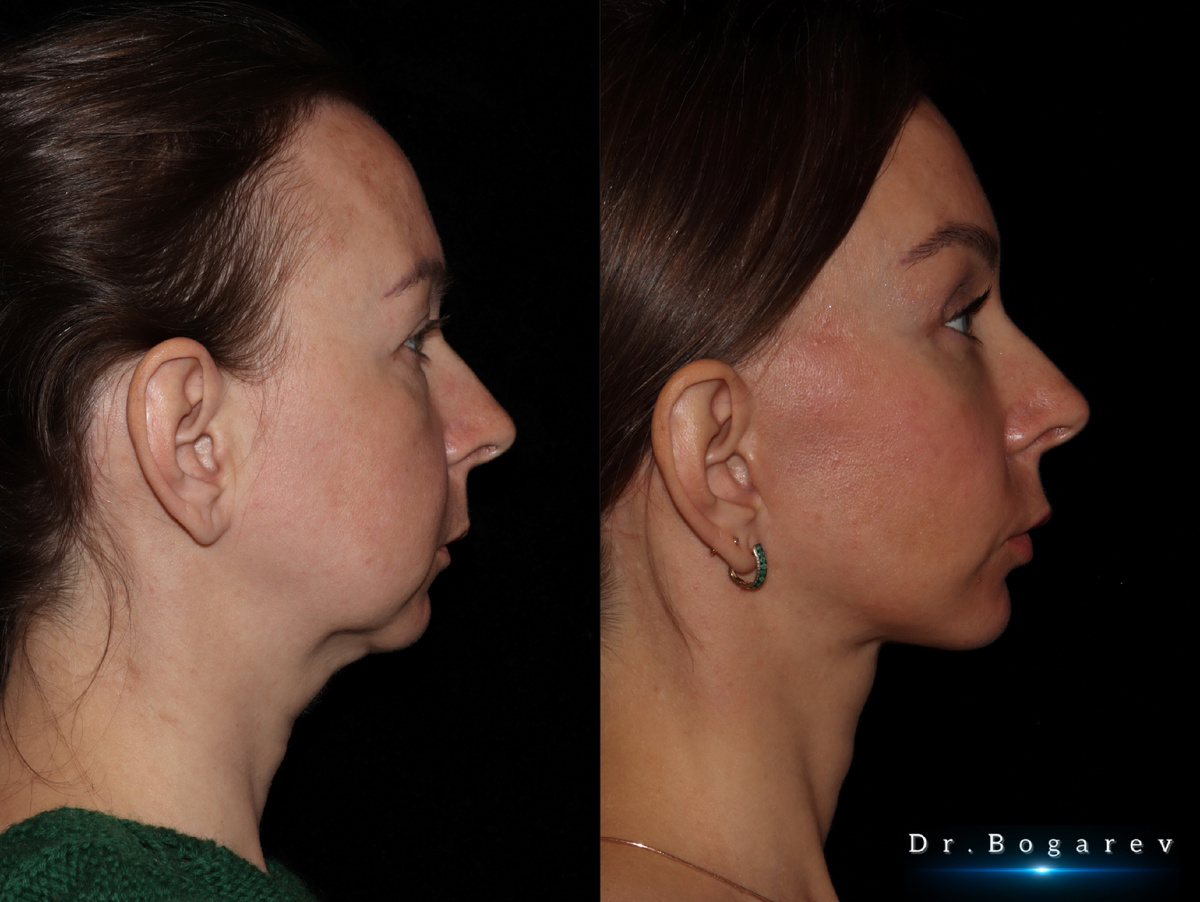 Результат комплексной омолаживающей операции на лице с восстановлением эстетики шеи (листайте галерею). Пластический хирург Александр Богарев.