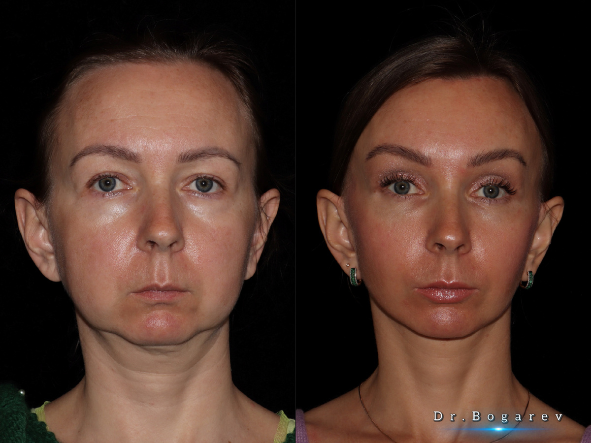 Результат комплексной омолаживающей операции на лице с восстановлением эстетики шеи. Пластический хирург Александр Богарев.