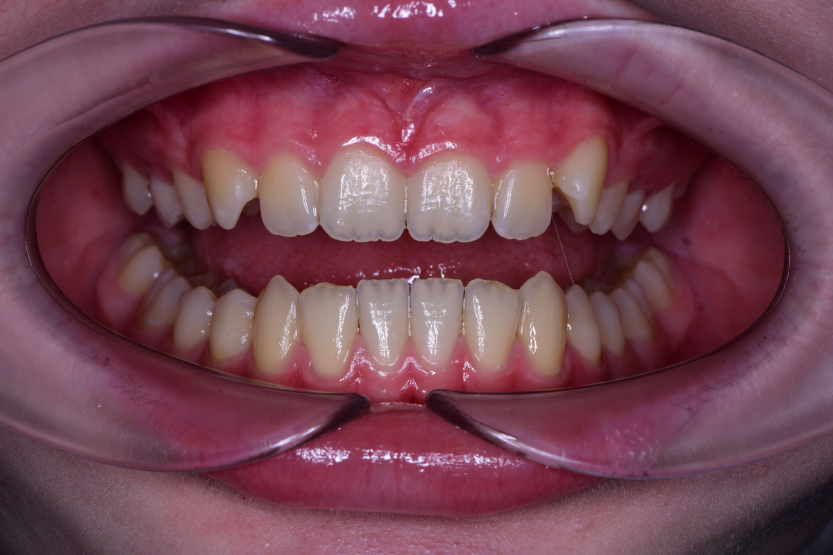 Машины десны выглядят массивными и воспаленными