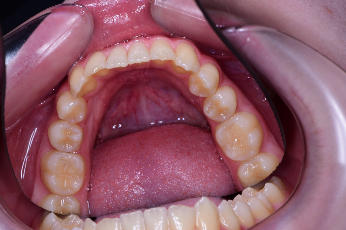 На нижней челюсти практически полностью прорезались «семерки»