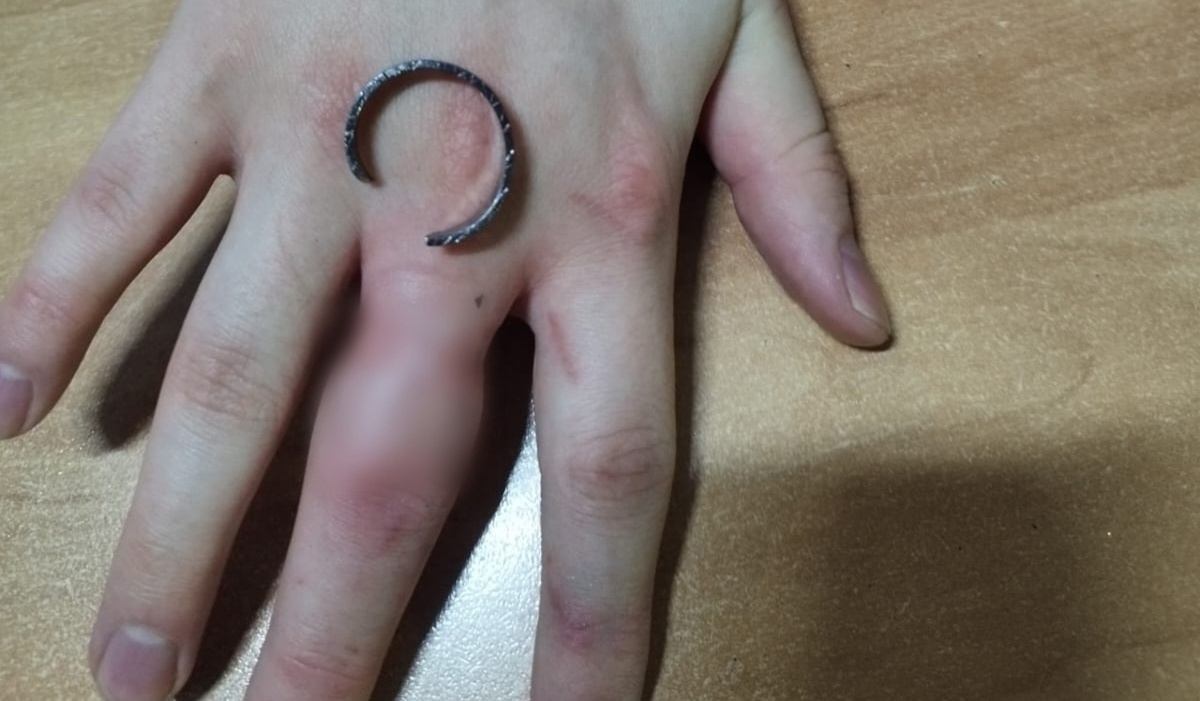    Курские спасатели сняли застрявшее кольцо с опухшего пальца парня