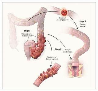 Дивертикулярная болезнь