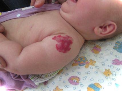 Малыш с гемангиомой 