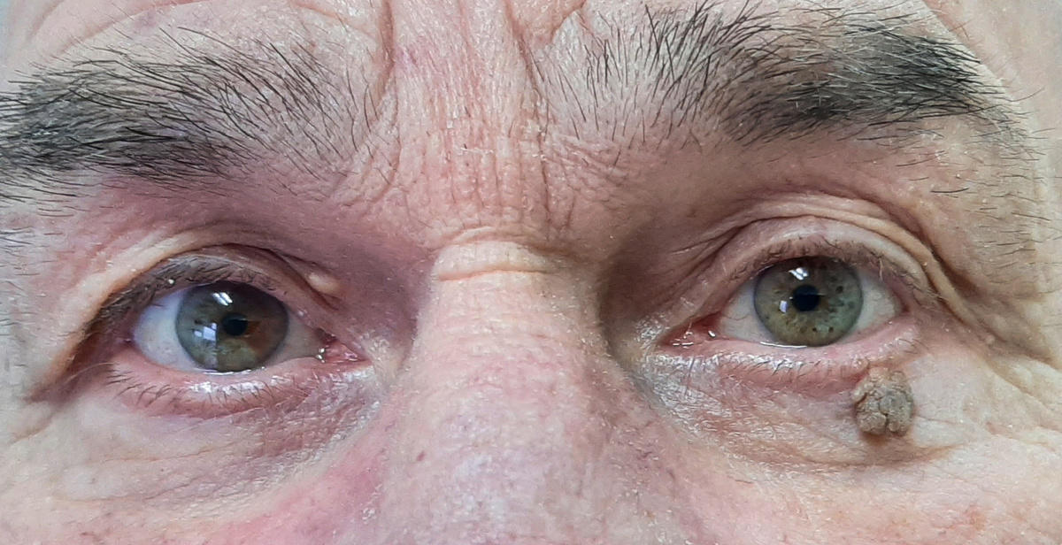 Папиллома нижнего века слева.  Также хорошо видна микроатерома верхнего века справа. Фото из архива автора.