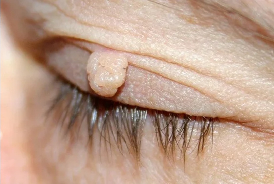 Папиллома кожи верхнего века. Фото из сети Интернет.