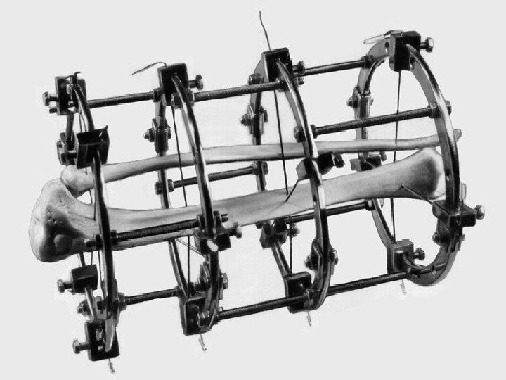 Аппарат Илизарова на ногу