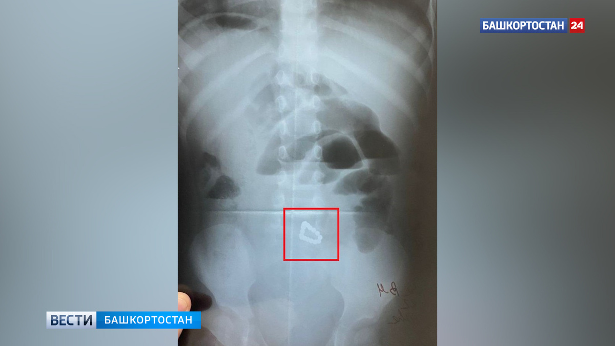    В Уфе 2-летняя девочка проглотила 17 магнитных шариков диаметром два миллиметра