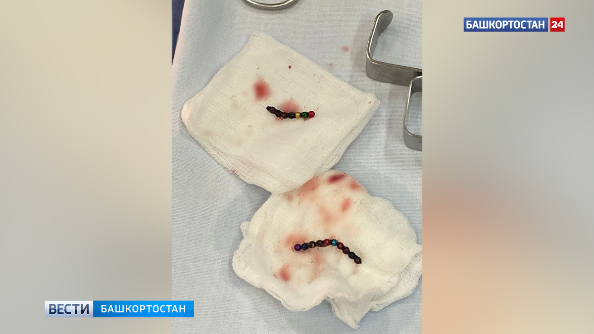    В Уфе 2-летняя девочка проглотила 17 магнитных шариков диаметром два миллиметра