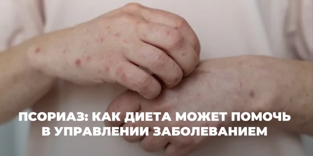 Псориаз: как диета может помочь в управлении заболеванием?