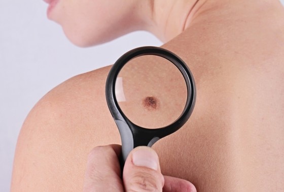    что будет, если сковырнуть родинку