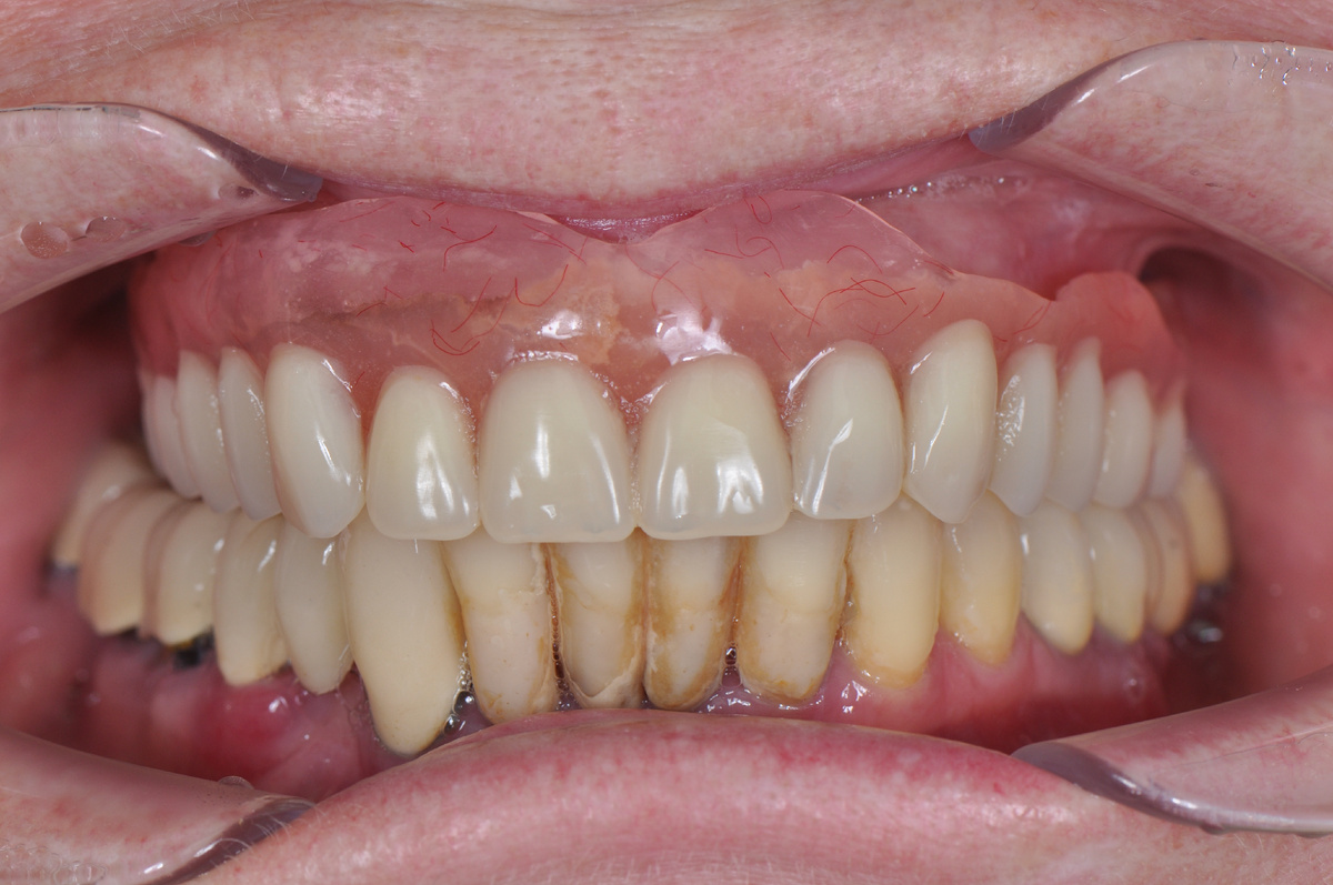 Марина пользовалась неточным съемным протезом