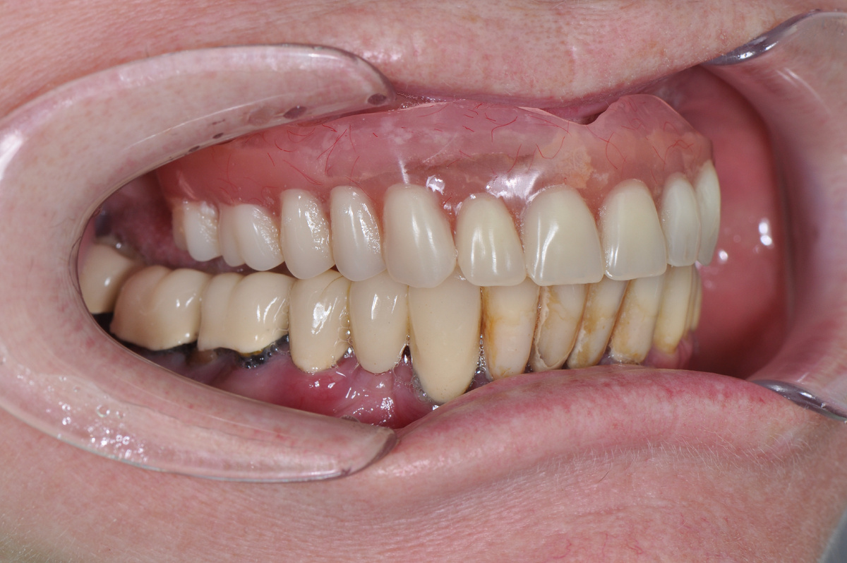 Нарушение смыкания