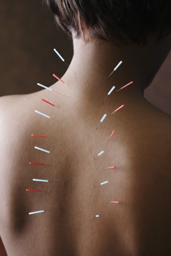 Найдено в Яндекс Картинках по запросу «иглоукалывание процедура в действии»