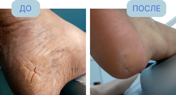 До и после аппаратного педикюра в центре подологии "Подоздрав"