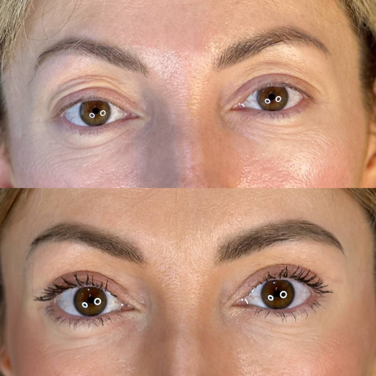 Верхняя блефаропластика. Минимальная травматизация, минимальный реабилитационный период