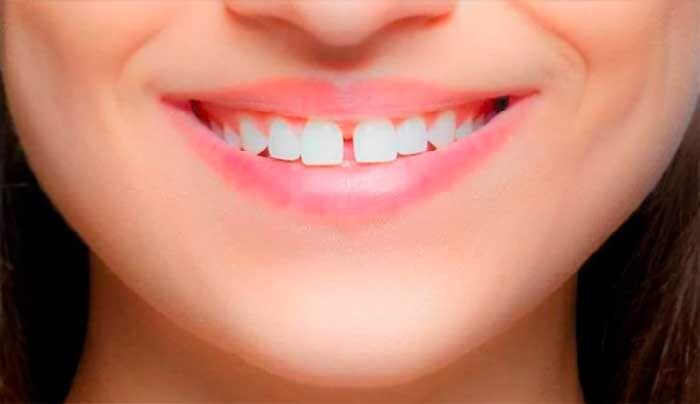 Диастема, или осторожно, щель!