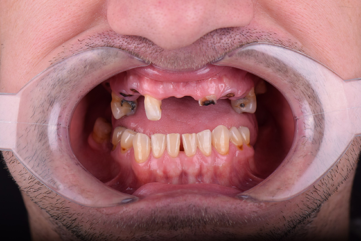 Фото пациента клиники ПРАЙМ: на верхней челюсти отсутствуют практически все зубы. 