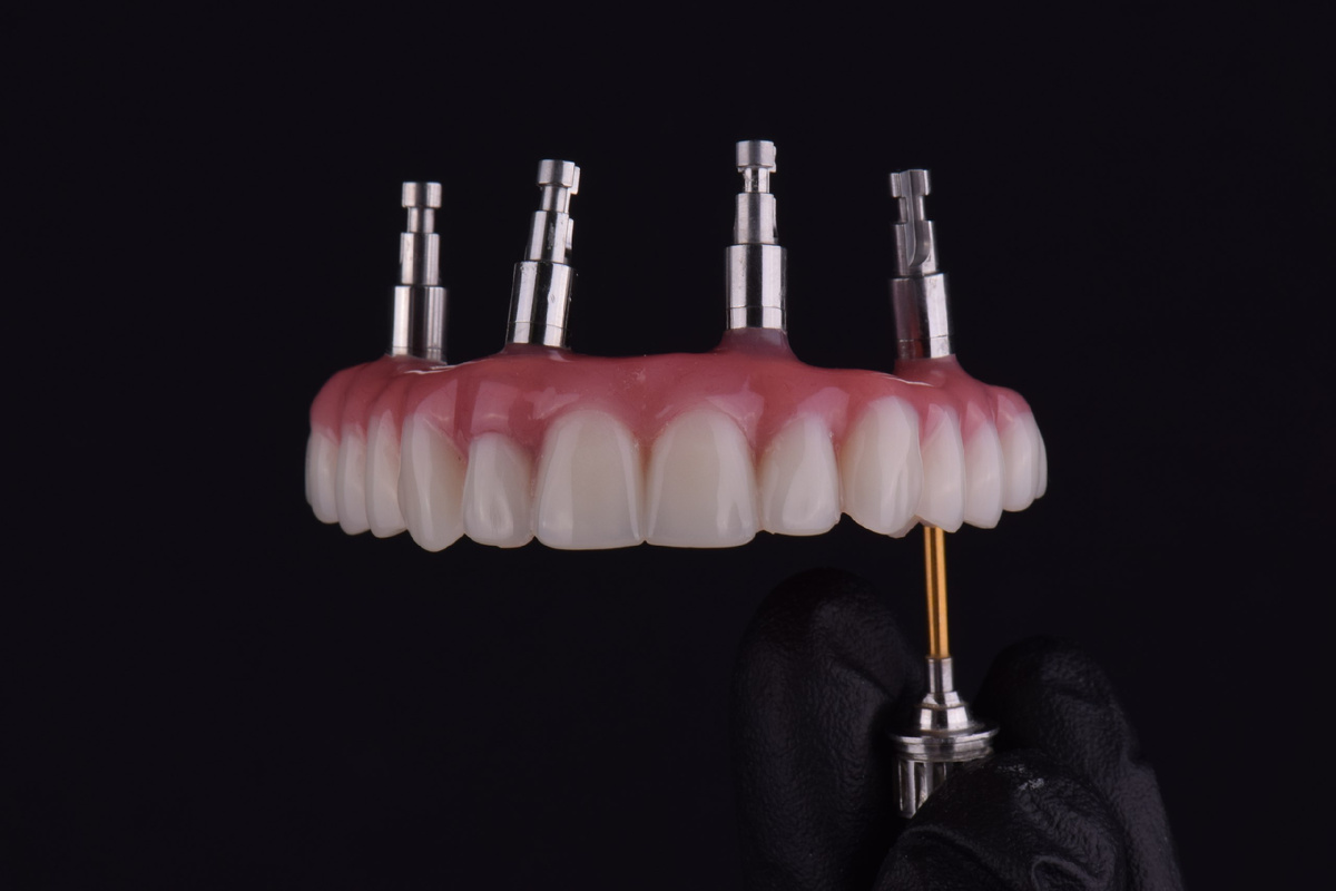 ALL-on-4: на четырёх имплантатах крепится несъёмный протез.