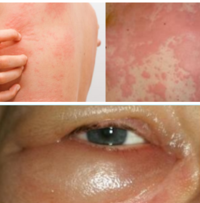 Варианты клинических проявлений холодовой аллергии