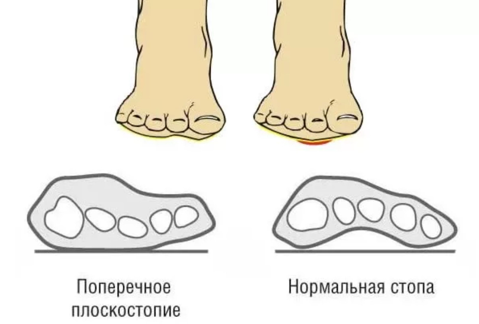 Ревматология в рисунках. Поперечный тест. Поперечный тест. Тест сжатия при ревматоидном артрите. Поперечный афиша.