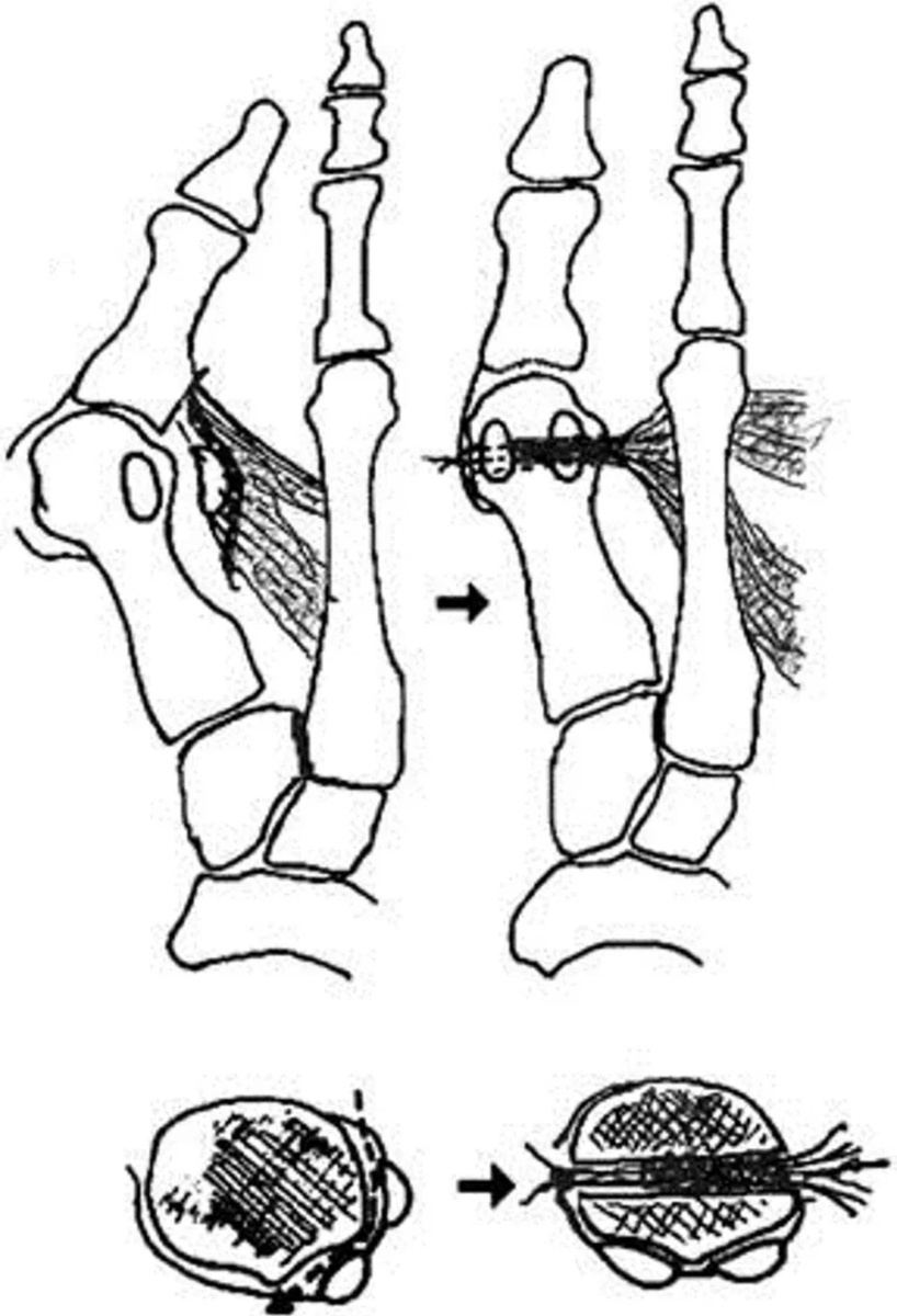 Операция по шеде брандесу. Остеотомия при вальгусная деформация. Операция шеде. Операция шеде. Операция шеде.