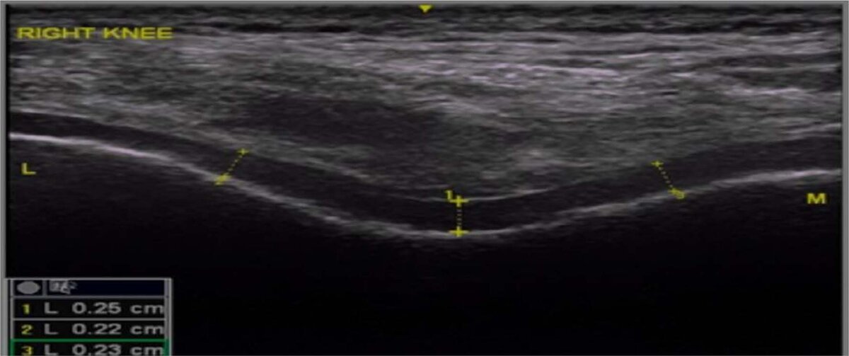 Рисунок 1 Ультразвуковое измерение толщины бедренного хряща на обоих коленях в трех различных местах (межмыщелковый, латеральный и медиальный)