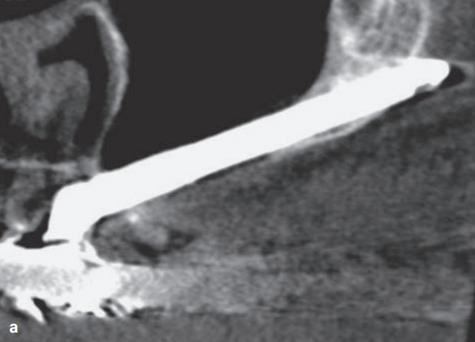 Aparicio C. A proposed classification for zygomatic implant patient based on the zygoma anatomy guided approach (ZAGA): A cross-sectional survey. Eur J Oral Implantol 
