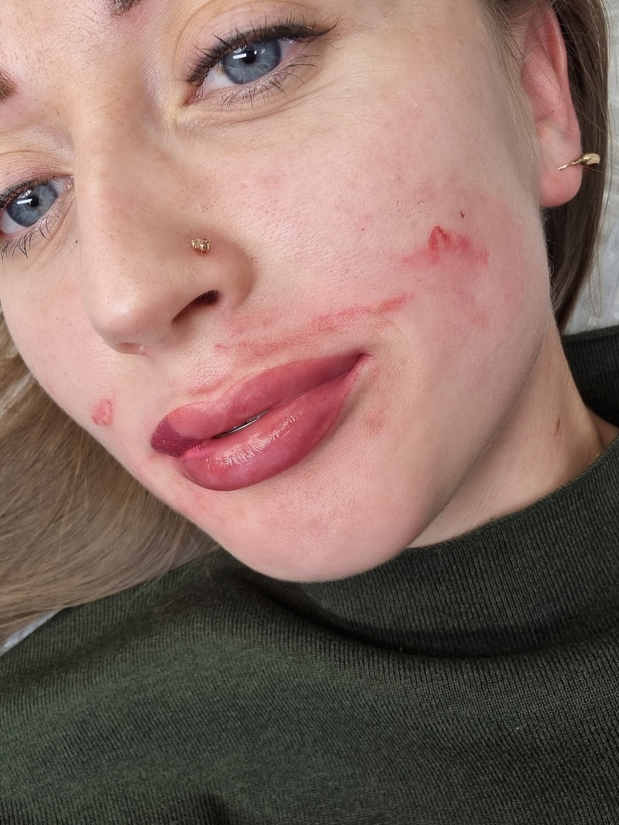 Перманент губ, на лице следы пигмента 