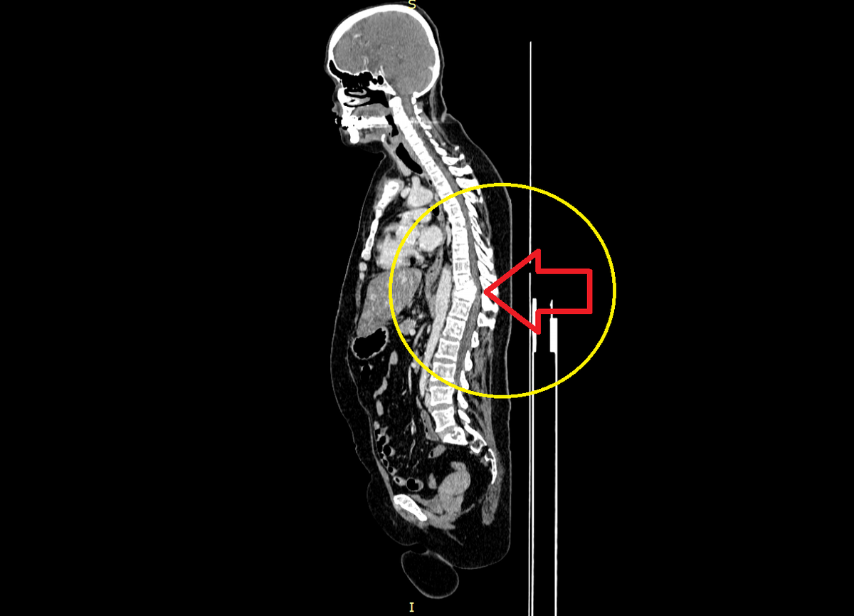 Стрелка указывает на сдавленный спинной мозг в области перелома позвонков