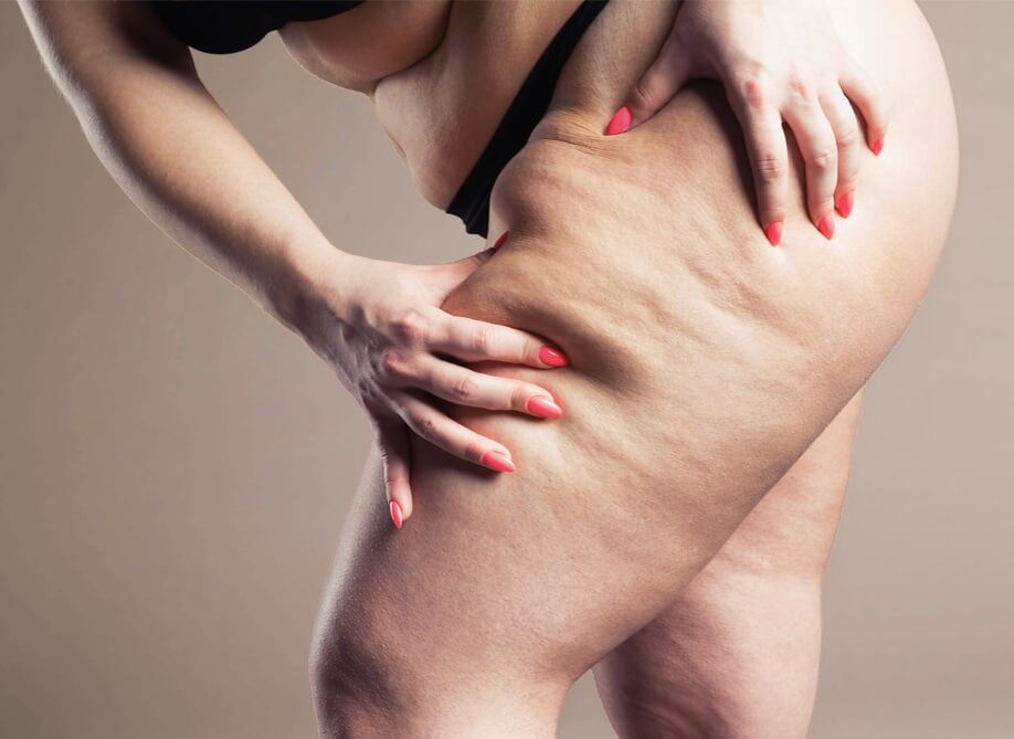 При липедеме проблема состоит не только в эстетическом дискомфорте: заболевание может сопровождаться болевым синдромом и вызывать психологические трудности, особенно на поздних его стадиях.