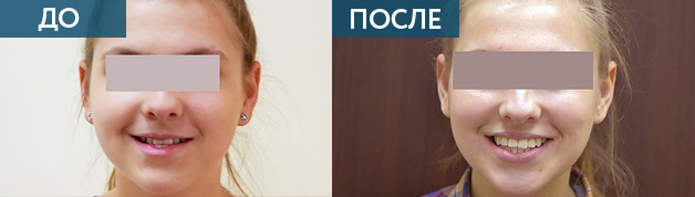Мезиальный прикус у взрослых. Лечени ДО и ПОСЛЕ