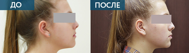 Мезиальный прикус лечение, ДО и ПОСЛЕ