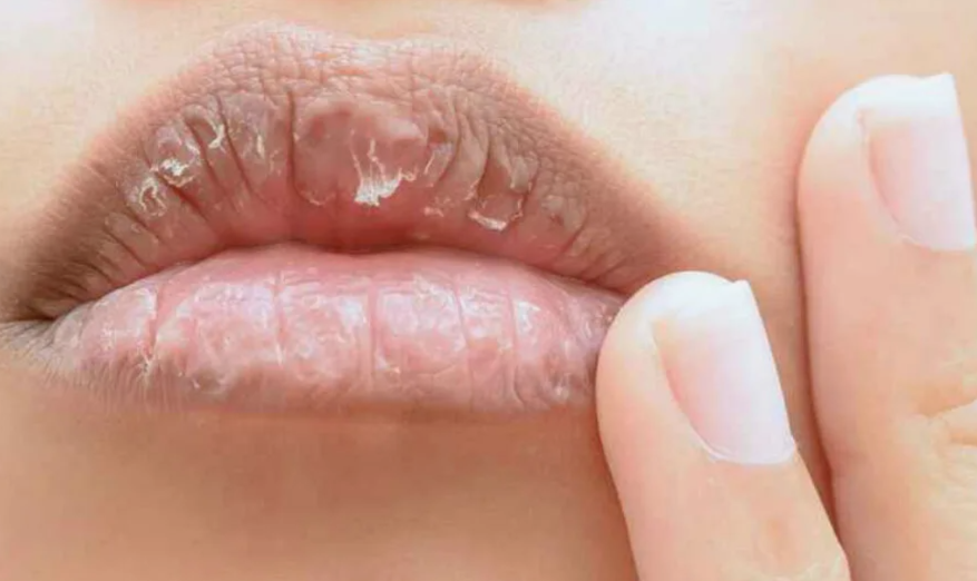 Почему зимой трескаются губы: причины и способы борьбы с сухостью