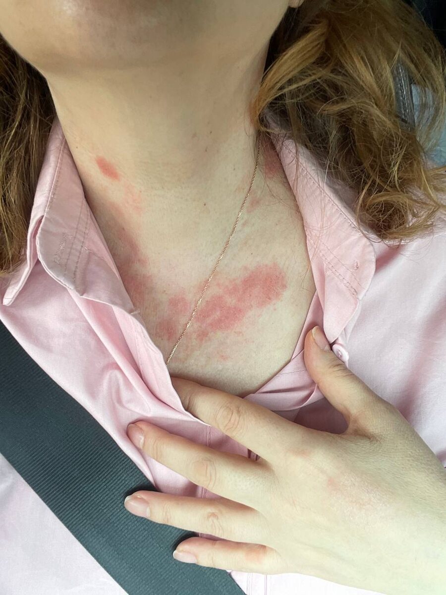 аллергия / Другая Кухня