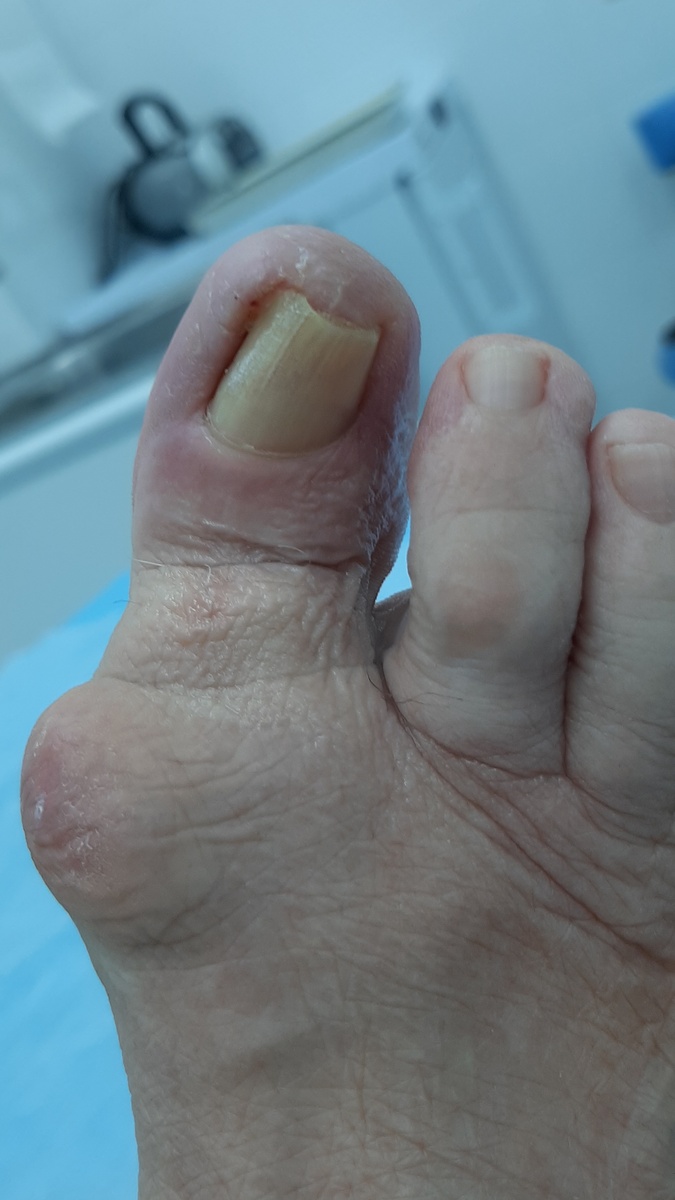 Состояние перед хирургической обработкой. Ногтевая пластинка несколько утолщена и U-образно деформирована. Имеется воспаление внутреннего ногтевого валика (на этом фото он слева). Также хорошо виден экзостоз (костно-хрящевой нарост) в области плюсне-фалангового сустава. Фото автора.