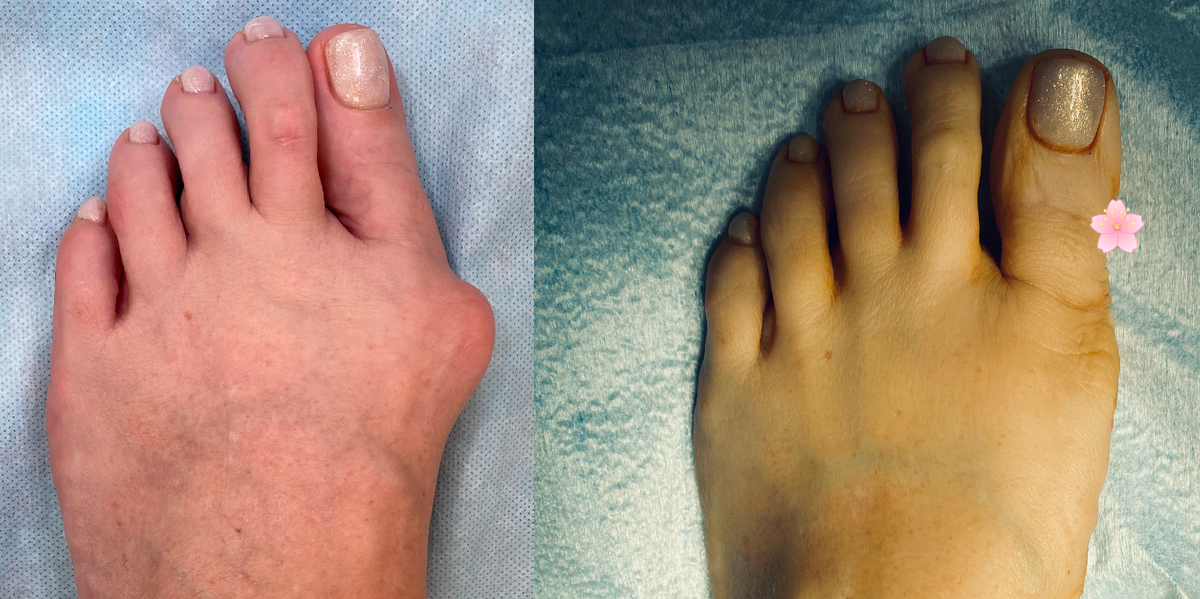 Пример пациента до операции и сразу после. Смайлик закрывает видимый шов. Фото опубликовано с разрешения пациента.