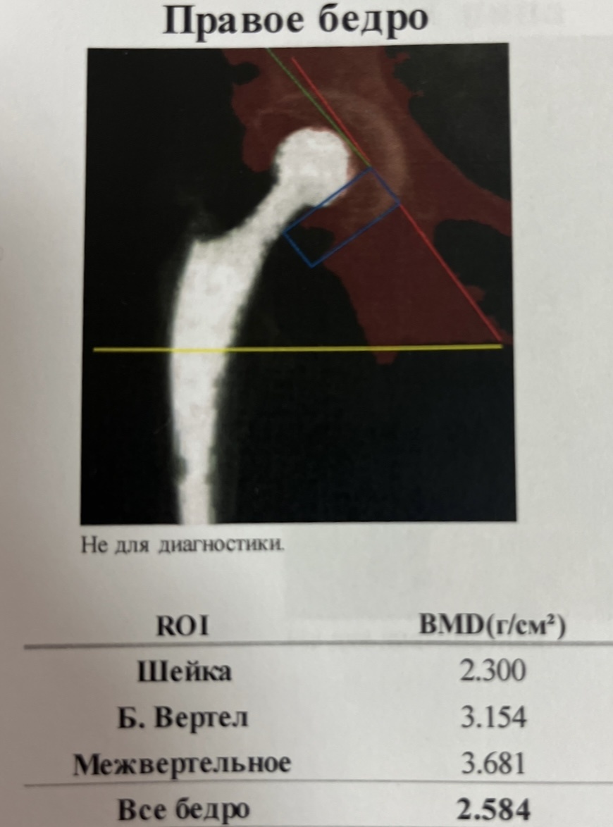Пример исследования с эндопротезом. 