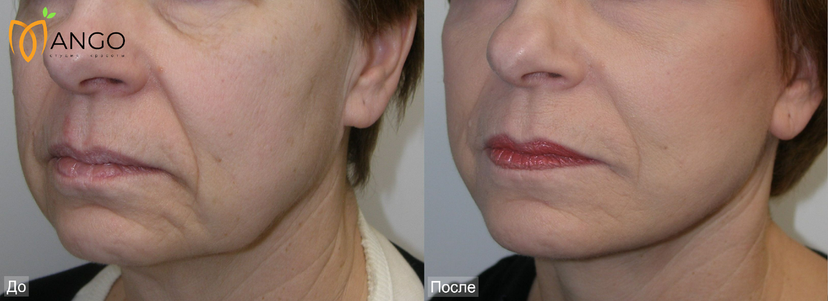 Подтяжка кожи лица после липоредукции