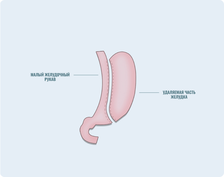 Продольная резекция желудка