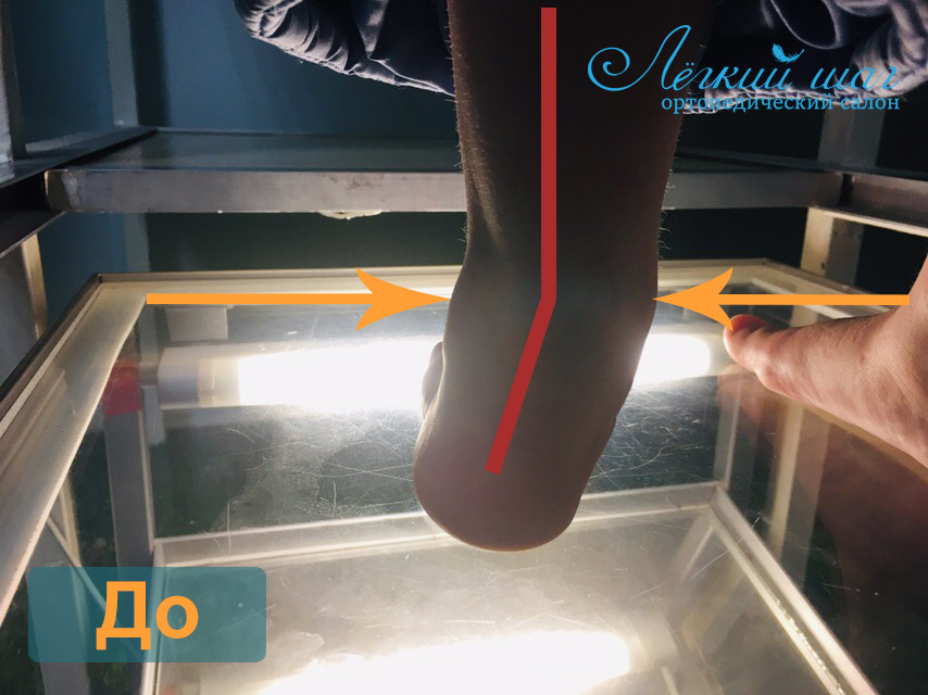 До лечения вальгуса