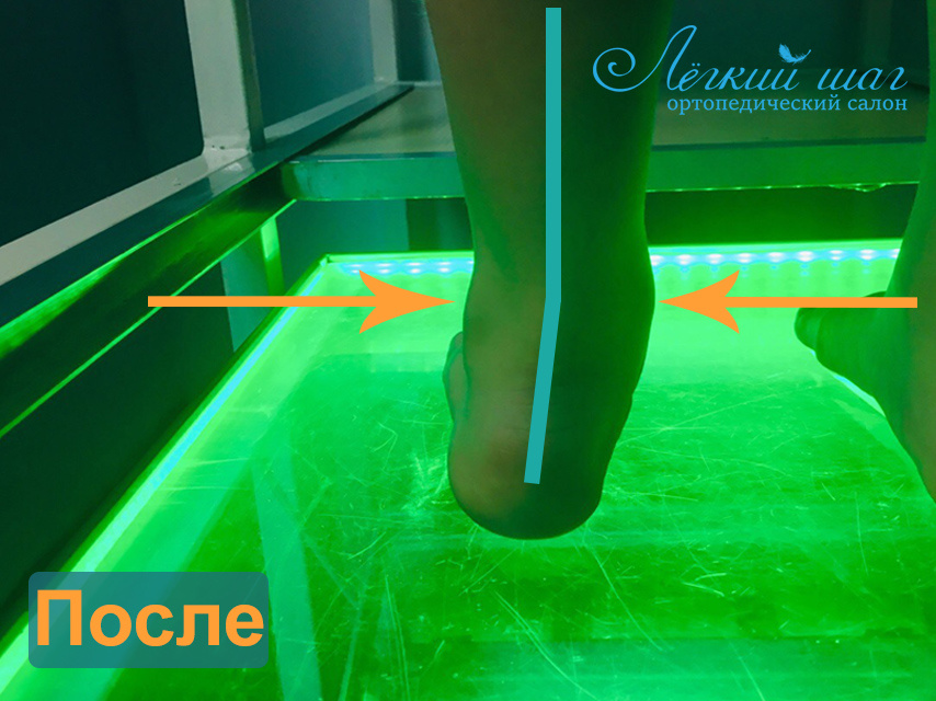 Момент лечения вальгуса