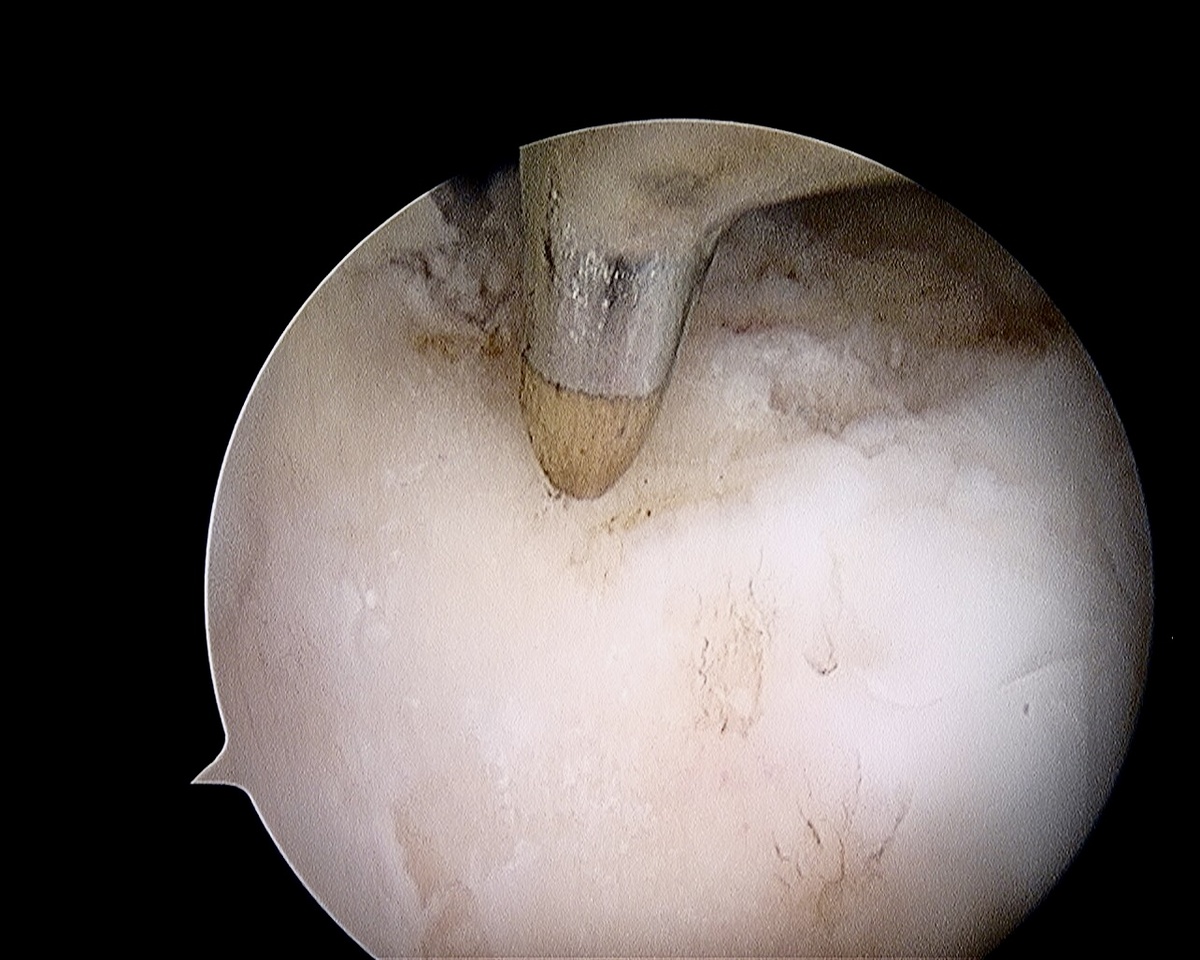 Инструмент внедрён в кость; на заднем плане видны уже сделанные отверстия
