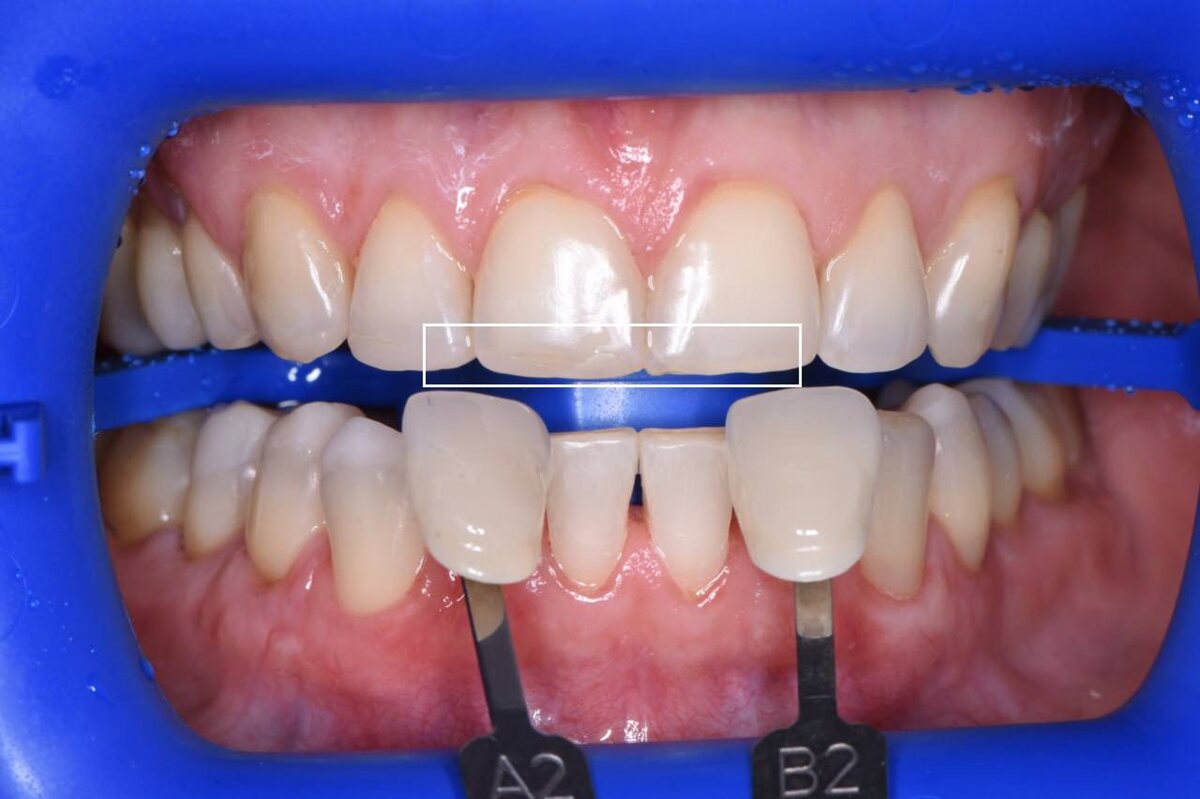 Временные реставрации