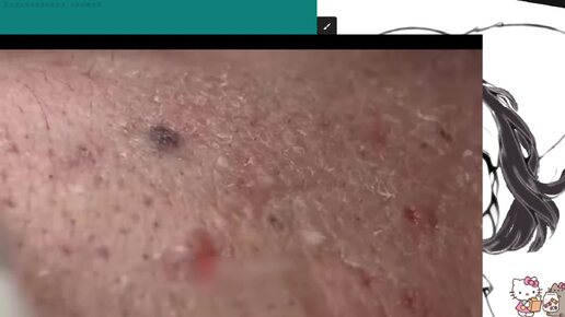 Механическая чистка лица от россыпи чёрных точек,прыщей и угрей ...