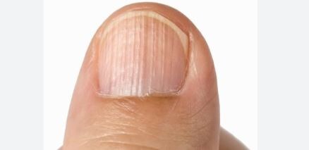 бороздки на ногтях / коллаж из интернета