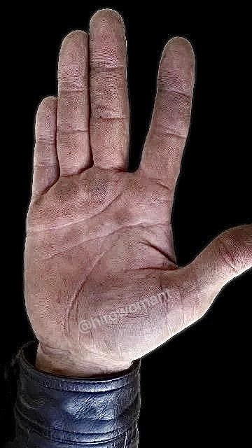 Мужчина, 32 года. Перелом шеи.