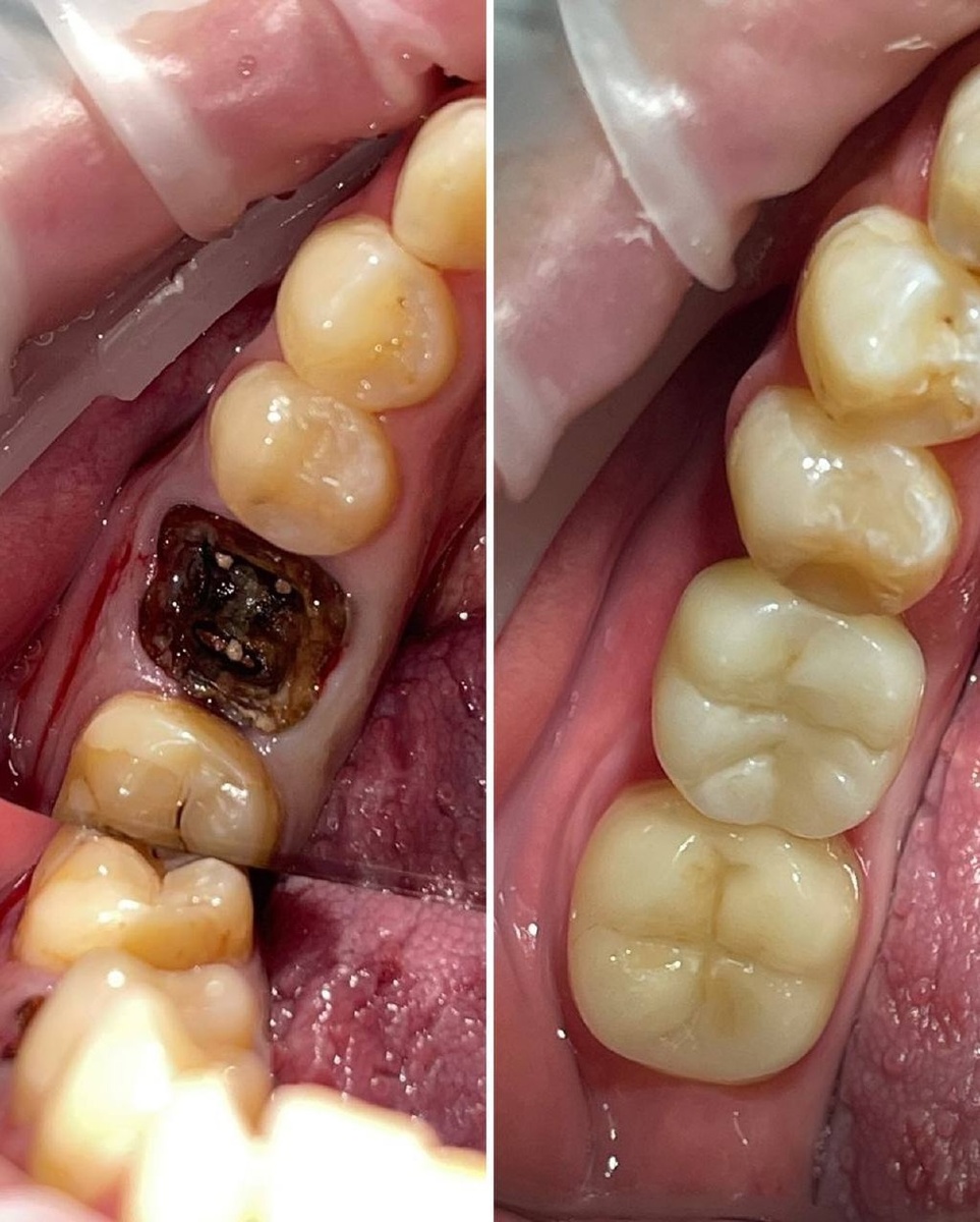 фото до - разрушенный зуб , не подлежит лечению и восстановлению 
после - провели одномоментную имплантатацию системой Shtrauman и через 2 месяца установлена коронка из диоксида циркония