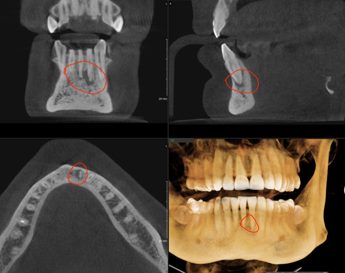 Периодонтит зуба 3.2