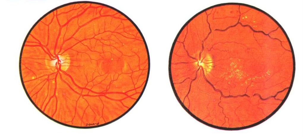  Слева нормальное глазное дно. Справа при гипертоничской болезни.