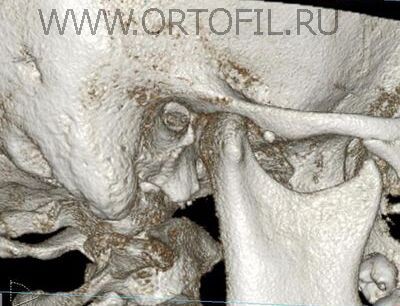 Компьютерная томограмма ВНЧС 